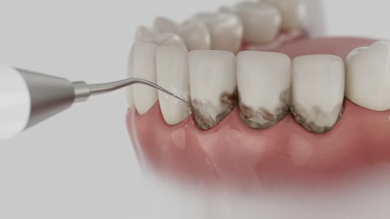 Trusted Wisdom Tooth Removal service in St. Cloud, MN - Dentist Open Now